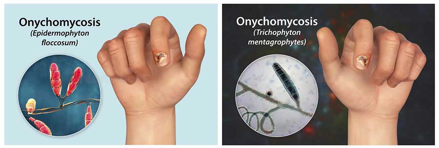 onychomycosis